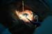 Incision4